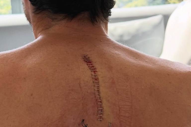 Bei dem Eingriff an Aleix Espargaros Rücken wurden vier Wirbel fixiert