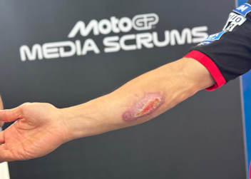 Marc Marquez hat von seinem Crash in Austin immer noch eine große Wunde