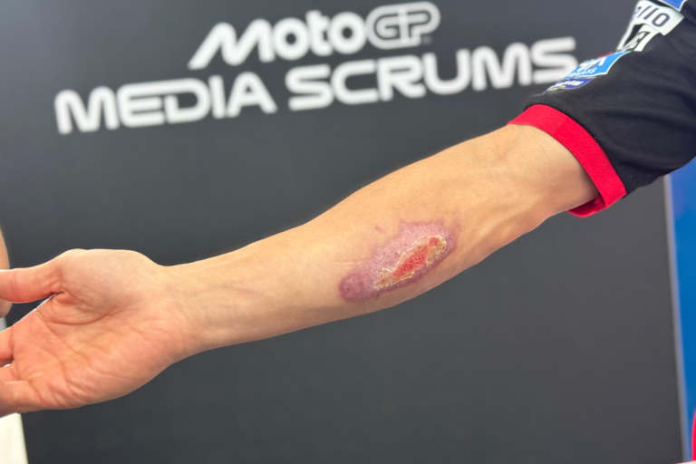 Marc Marquez hat von seinem Crash in Austin immer noch eine große Wunde