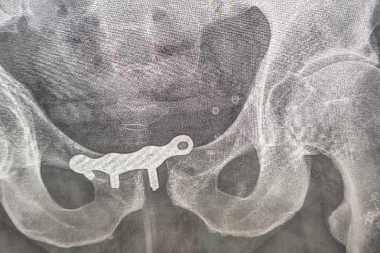 Gut zu sehen, wie die Schraube der Platte nicht mehr im Knochen ist