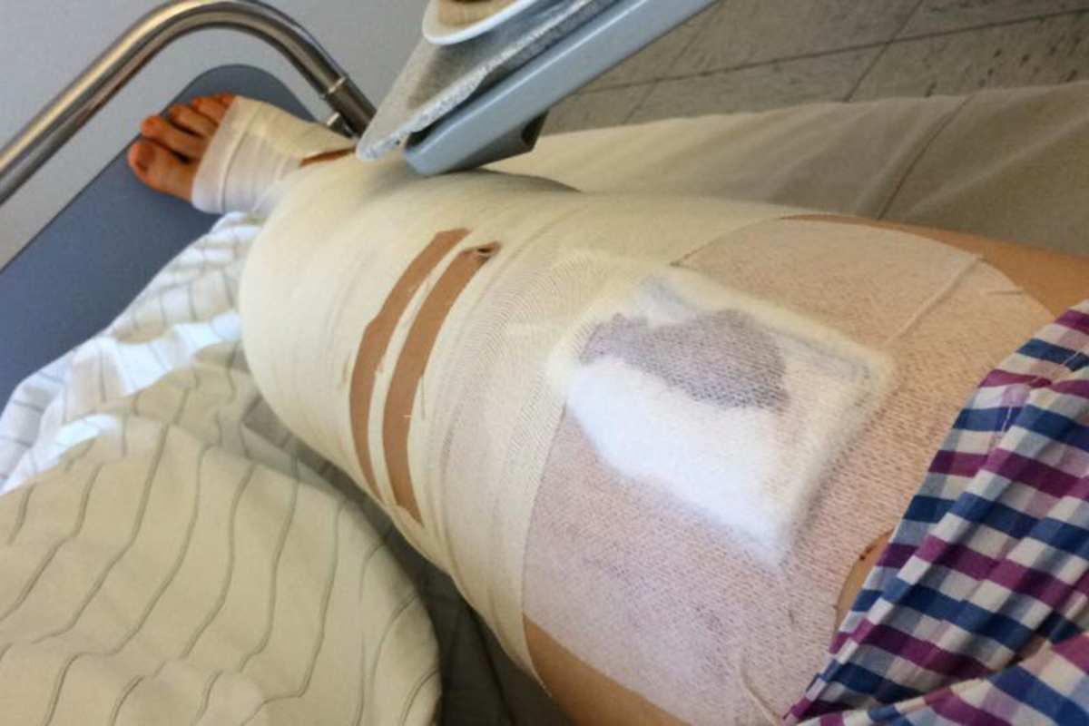 Schenkel ohne Metall