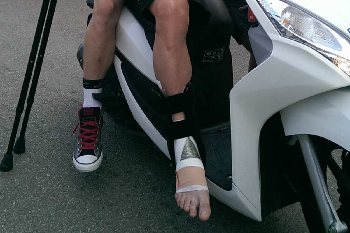 So sah der Knöchel von Crutchlow am Sonntag nach dem Rennen aus; hinter ihm auf dem Roller sitzt Assistent Dakota Mamola