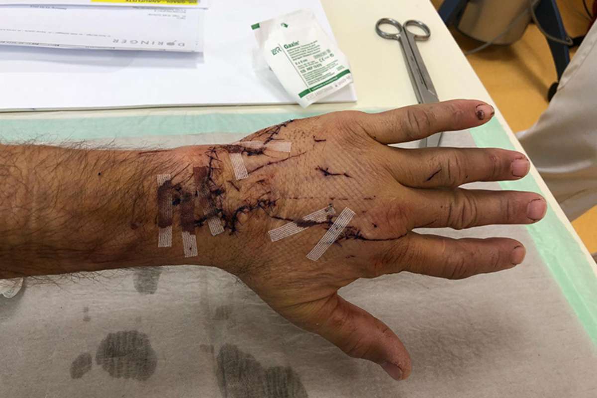 Das linke Bein von Franz Zorn wurde übel zugerichtet