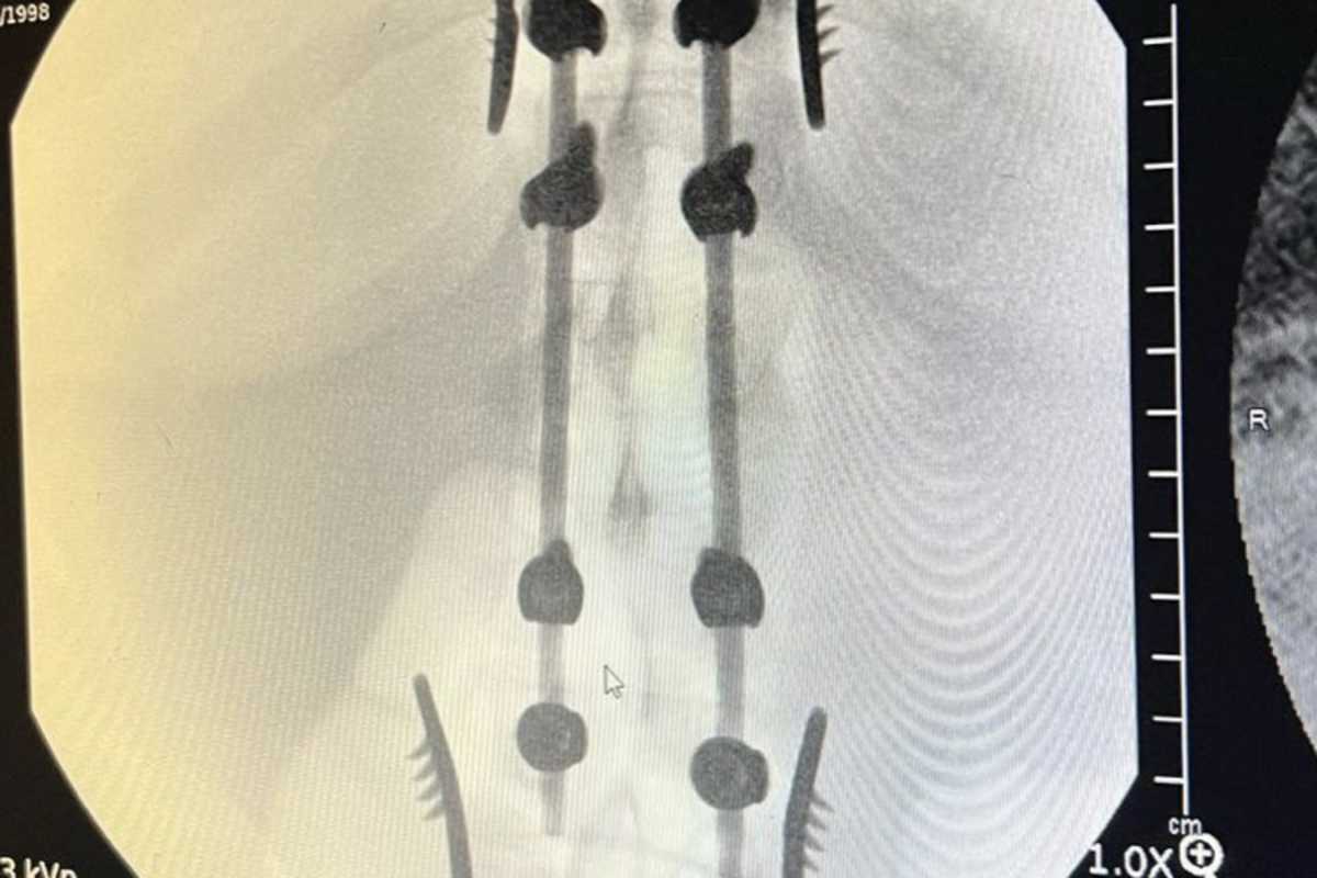 Die Wirbelsäule wurde operiert