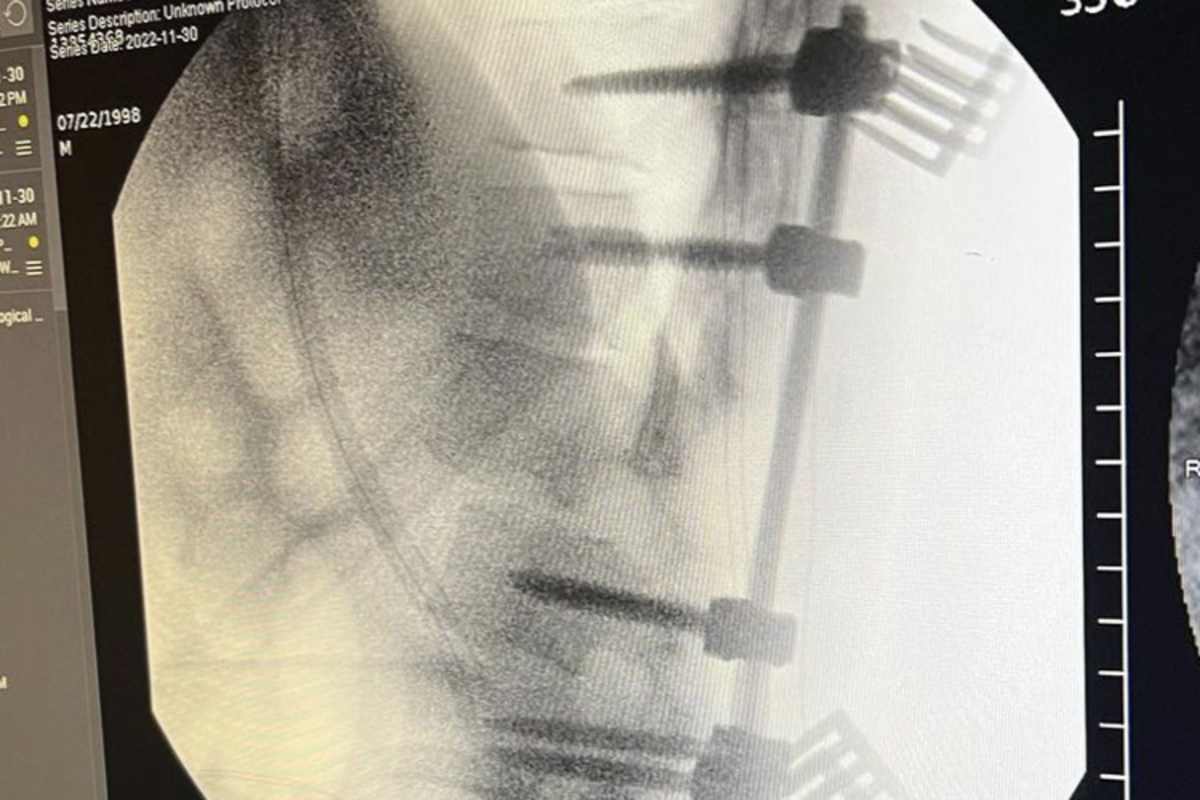 Die Wirbelsäule wurde stabilisiert und verschraubt