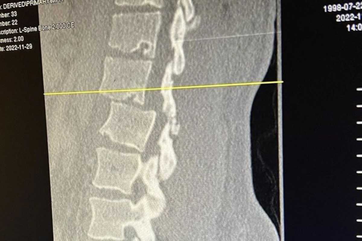 Die Wirbel wurden bei dem Crash verschoben