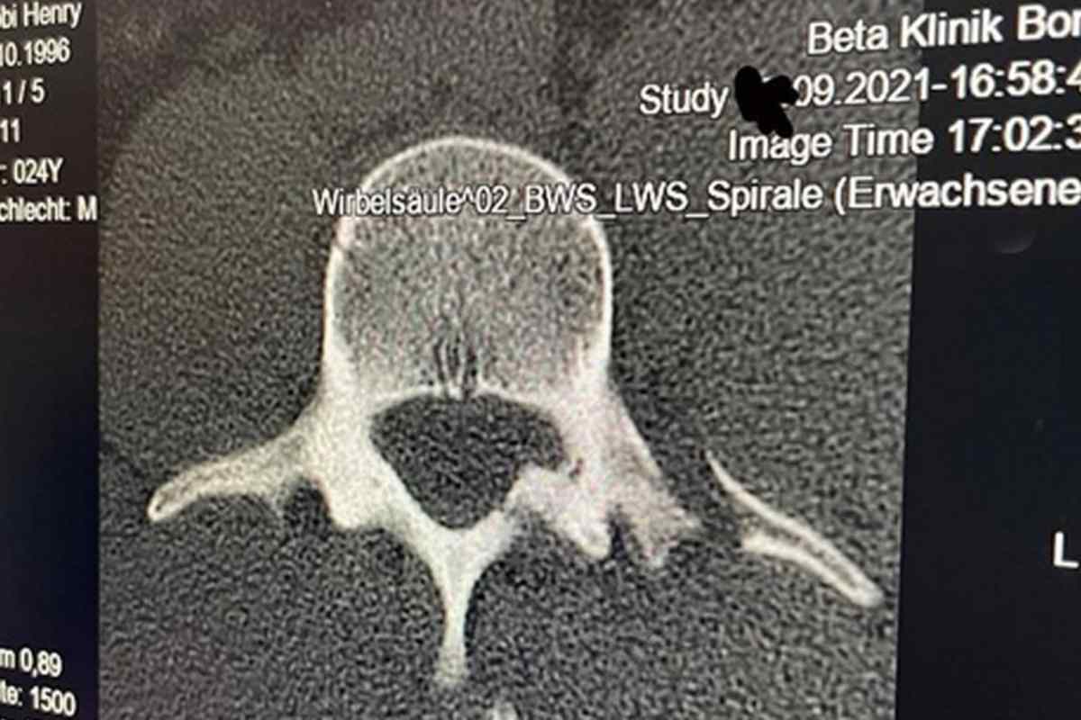 Der gebrochene Querfortsatz verursachte Schmerzen über Wochen