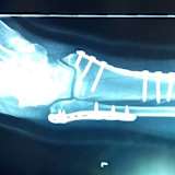 Der Knöchelbruch von Manfred Wechselberger wurde in Frankreich optimal versorgt