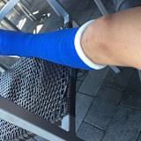 Jonas Geitner hat ein Gips-Bein