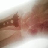 Der linke Unterarm von Tommy Searle wurde operiert