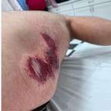 Schürfwunden von Danilo Petrucci