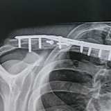 Das zertrümmerte Schlüsselbein nach der OP