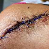 Kein Halloween, sondern Patrick Hobelsbergers Ellbogen