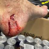 Der lädierte Fuß von Franz Zorn