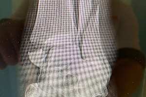 Der Bruch im linken Bein vor