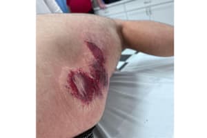 Schürfwunden von Danilo Petrucci