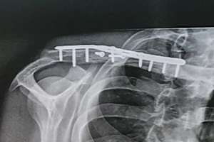 Das zertrümmerte Schlüsselbein nach der OP