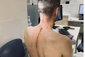 Michael Sandner nach der OP