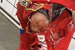 Die Brandwunden von Antonio Cairoli nach seinem Crash in Spring Creek