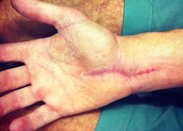 Die Hand von Alexander Lundh