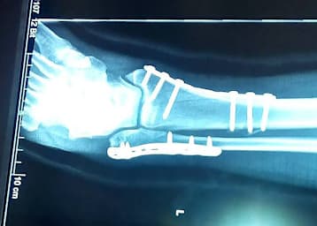 Der Knöchelbruch von Manfred Wechselberger wurde in Frankreich optimal versorgt