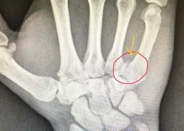 Die rechte Hand von Dominik Vincon