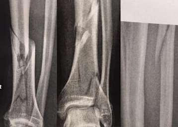 Das war mal ein Unterschenkel