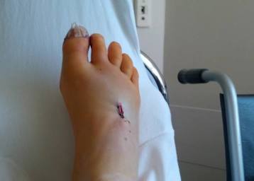 Katrin Meyers Fuss frisch verdrahtet