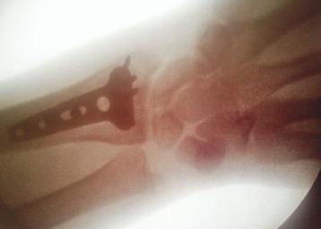 Der linke Unterarm von Tommy Searle wurde operiert