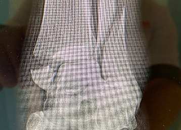 Der Bruch im linken Bein vor