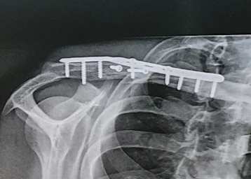 Das zertrümmerte Schlüsselbein nach der OP