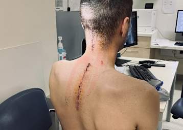 Michael Sandner nach der OP