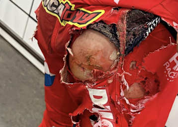 Die Brandwunden von Antonio Cairoli nach seinem Crash in Spring Creek