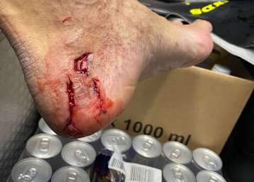 Der lädierte Fuß von Franz Zorn