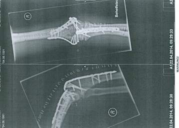 Drei Metallplatten und 20 Schrauben waren nötig, um den Arm zu richten