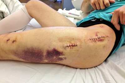 Jonathan Reas Verletzungen werden Zeit brauchen