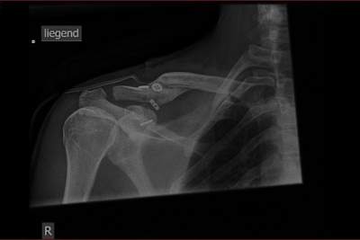 Knoblochs Schulter von innen