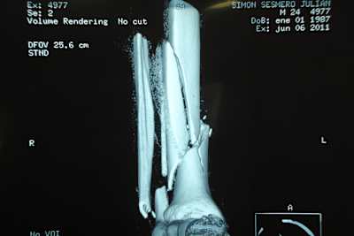 Röntgenaufnahme von Simóns Bein vor der OP