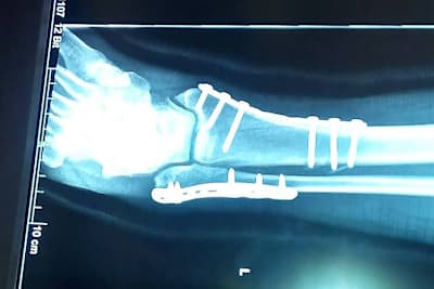 Der Knöchelbruch von Manfred Wechselberger wurde in Frankreich optimal versorgt