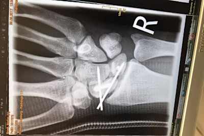 Stefan Bradls rechte Hand: Zwei Stifte und ein Draht wurden eingesetzt