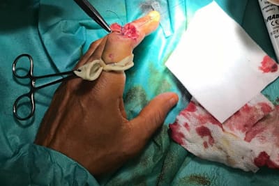 Cal Crutchlows Finger musste operiert werden