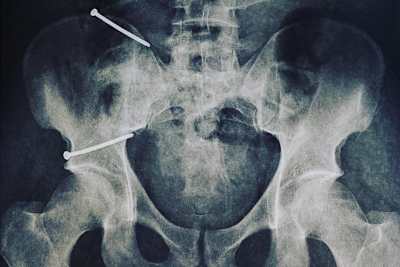 Der Riss in Dominique Aegerters Beckenschaufel wurde fixiert