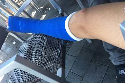 Jonas Geitner hat ein Gips-Bein