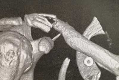 Gines Schlüsselbein kurz vor dem Rennen