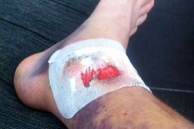 Das Schienbein von Arie Vos