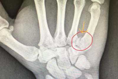 Die rechte Hand von Dominik Vincon