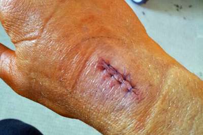 Vor zwei Wochen sah die Hand von Jones noch so aus