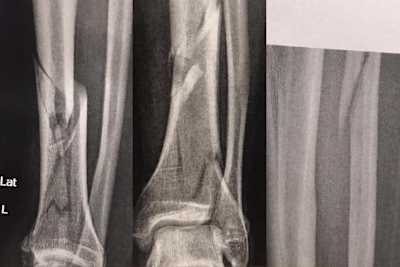 Das war mal ein Unterschenkel