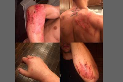 Roczens Verletzungen nach seinem Crash in San Diego