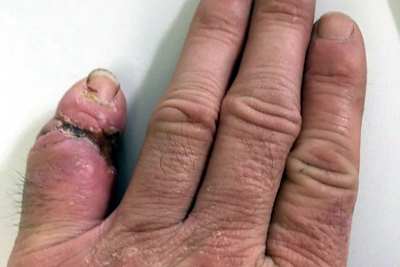 Jörg Teucherts Finger sieht echt übel aus